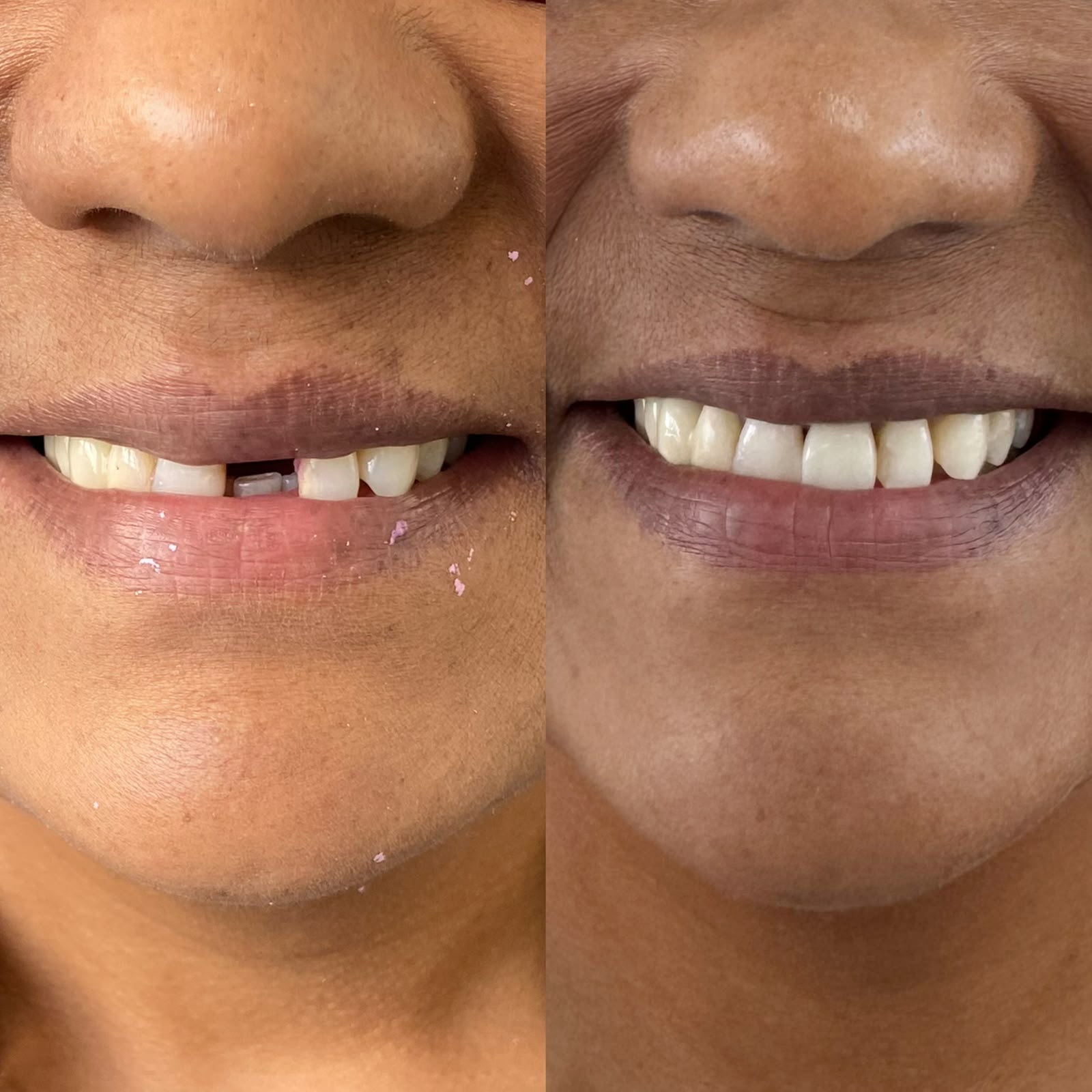 Antes e depois 4